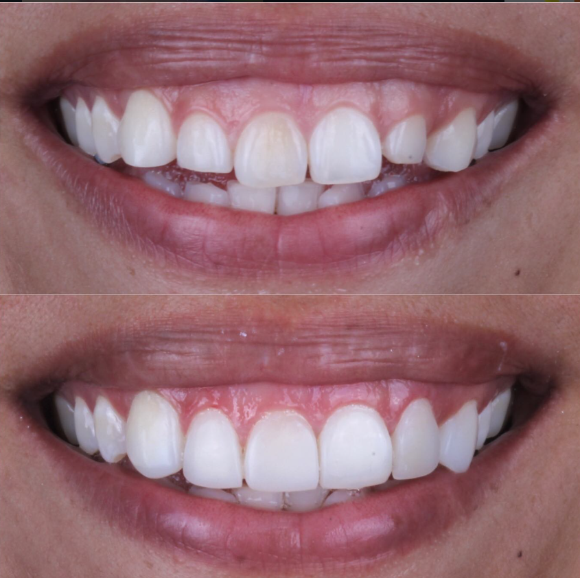 Caso clínico dental antes y después