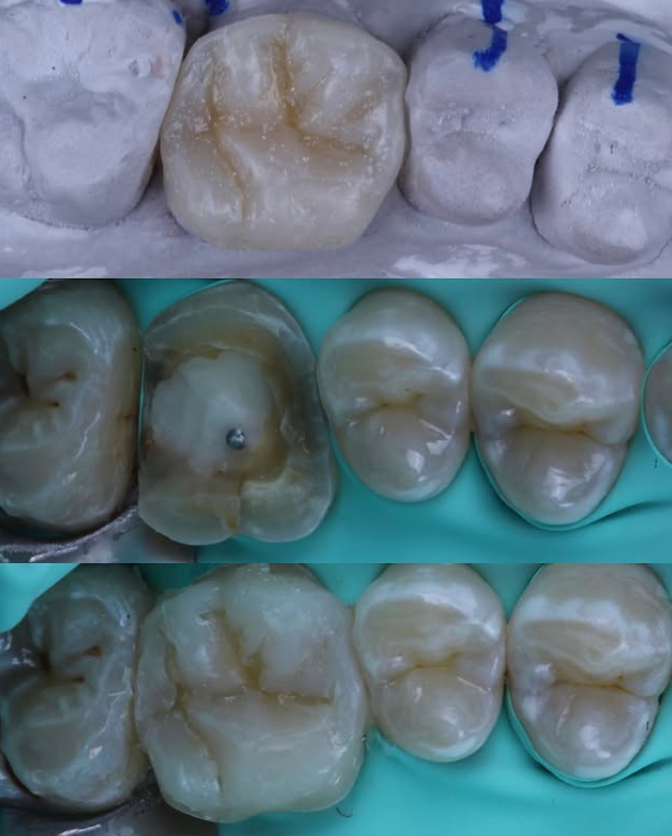 Caso clínico de restauración dental