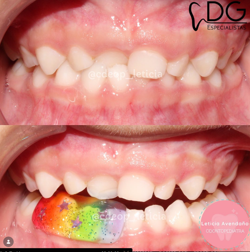 Caso clínico dental infantil